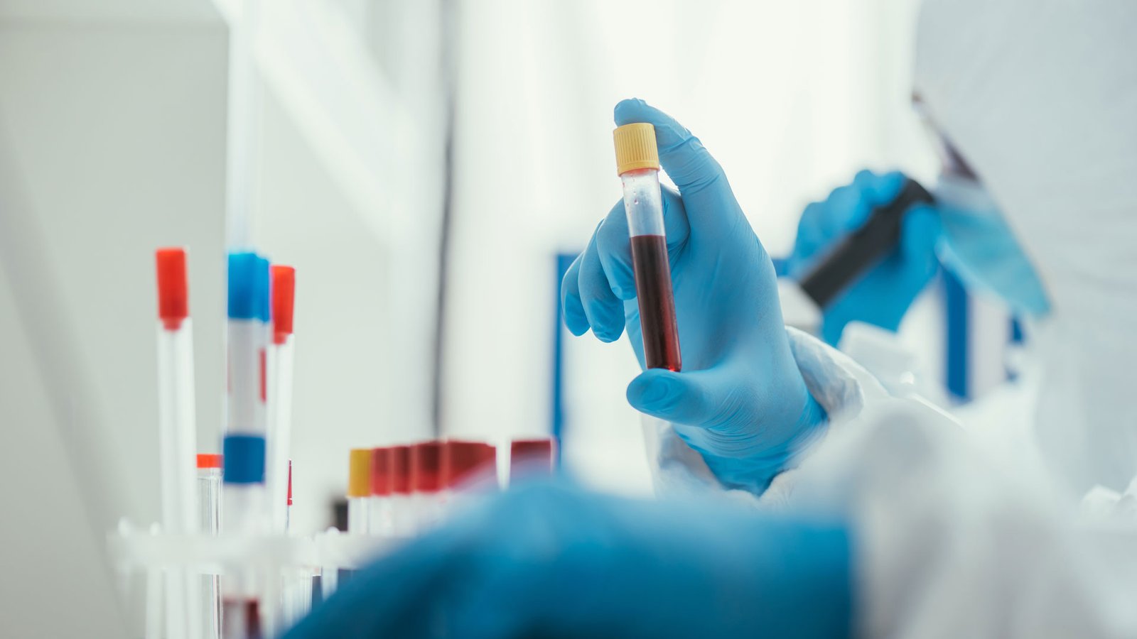 Prueba PSA en diagnostico de cáncer de próstata