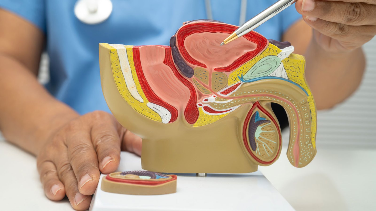 Tacto rectal en cáncer de próstata