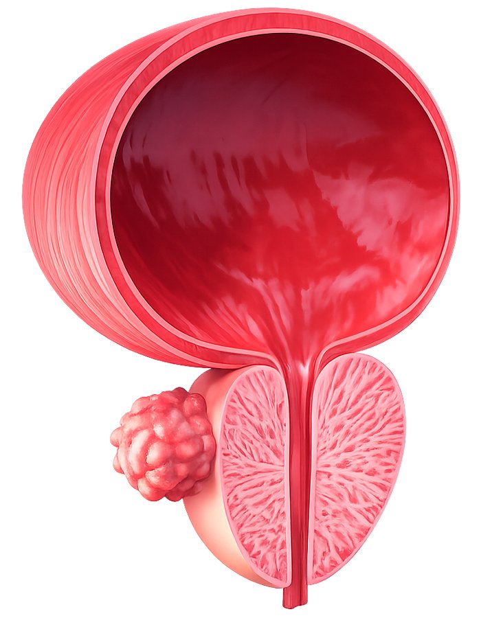 imagen de cancer de prostata